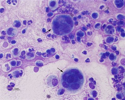 Multinucleated Giant Cell Archives Eclinpath