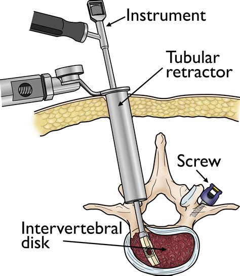 Minimally Invasive Spine Surgery Orthoinfo Aaos