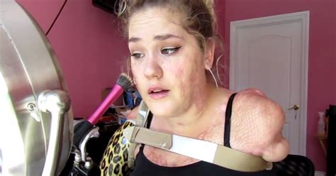 She Loses All Four Limbs In A Span Of 24 Hours When Disease Ravages Her Body Now Shes Filming