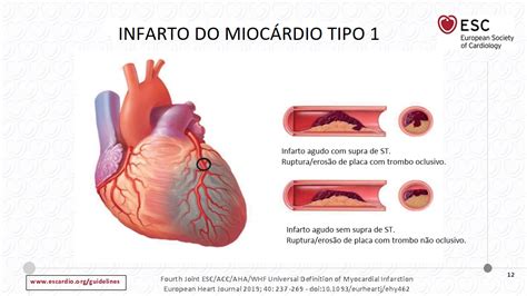 Infarto Sem Supra é Grave