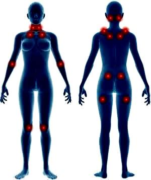In this video i will explain what we know about fibromyalgia. Fibromyalgia Tender Points