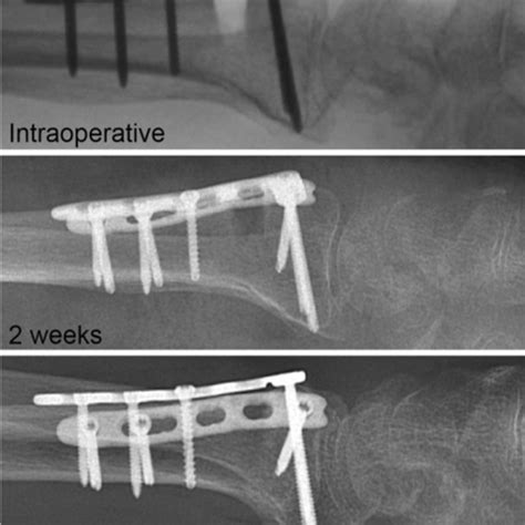 Correction Of The Deformity And Healing Of The Osteotomy Gap Download