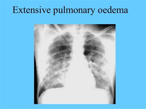 Abnormal Chest Xray Ppt