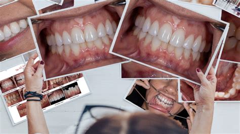 Dental Photography Basics Standard Views And Photo Series Options For