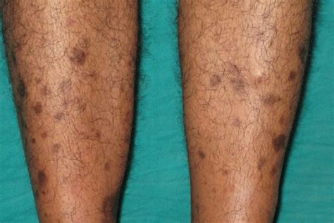 What Does Diabetic Skin Look Like Symptoms And Pictures