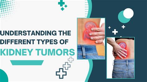 Understanding The Different Types Of Kidney Tumors
