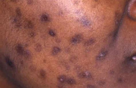 Dark Spots Causes Scars Sun Shaving Bras And More Skincarederm