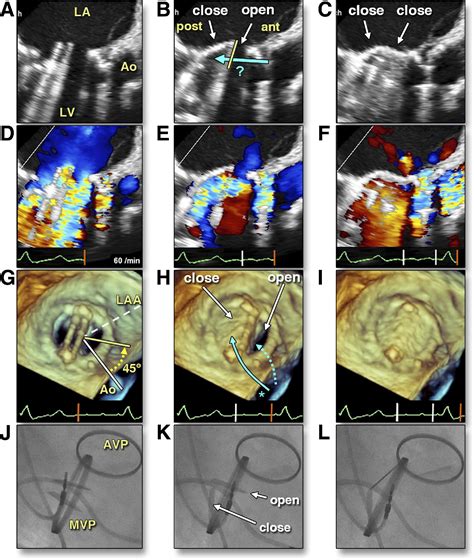 Stenosis Of A Mechanical Mitral Valve Prosthesis By Eccentric