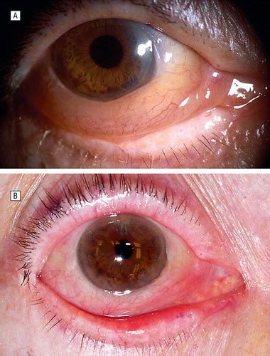 Postoperative Chemosis After Cosmetic Eyelid Surgery Surgical