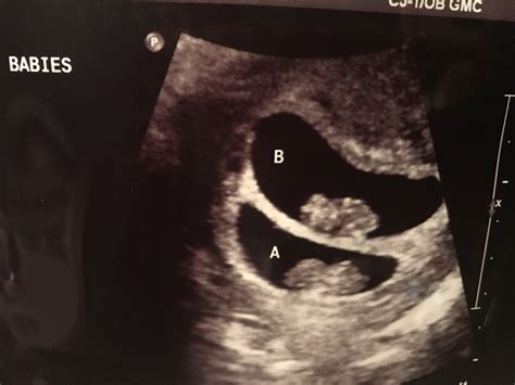 9 Weeks Pregnant With Twins Ultrasound Symptoms And Physical Acticity