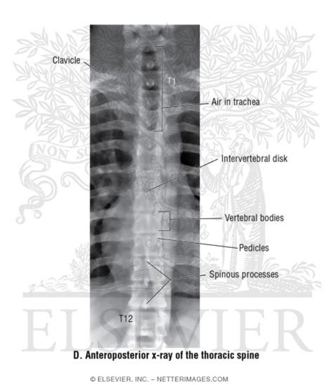 Anteroposterior X Ray Of The Thoracic Spine