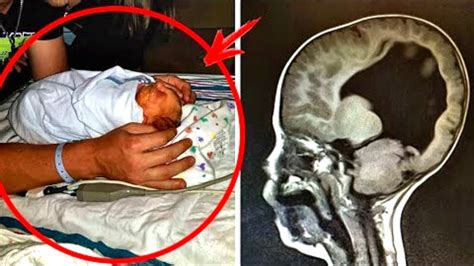 This Child Was Born Without A Brain But What Happened After 3 Years Was
