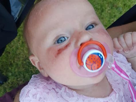 Vanicream sensitive sunscreen is a simplysunsafe favorite that will do a great job if you have heat rash. Banana Boat baby sunscreen: Mother's warning after baby suffers 'chemical burn' | Adelaide Now