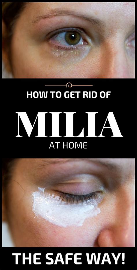 Whiteheads Or White Spots Also Called Milia Appear On The Face When