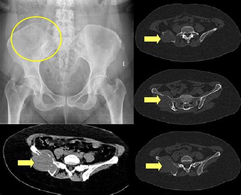 Figure 1 From Lesions On Pelvic Bones Spectrum And Radiologic Findings