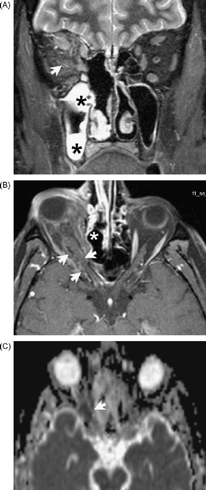 Click on the link to view a sample search on this topic. Mucormycosis arising from the ethmoid sinus in a 47-year ...