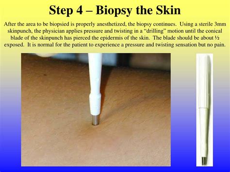 Ppt Johns Hopkins Cutaneous Nerve Laboratory Skin Biopsy Procedure