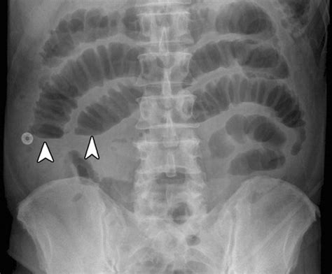 Imaging Patients With Acute Abdominal Pain Radiology