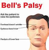 Maybe you would like to learn more about one of these? Bells palsy idiopathic facial paralysis Homeopathic Treatment