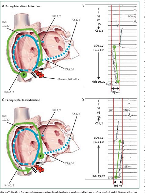 Catheter Ablation Of Atrial Arrhythmias State Of The Art Semantic