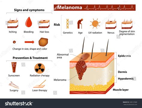 Melanoma Skin Cancer Infographics Medical Infographic Stock Vector