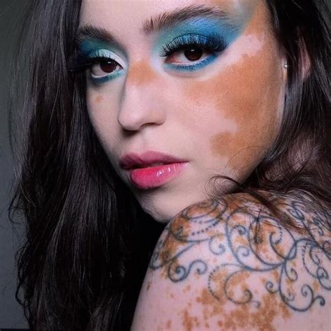 Woman With Vitiligo Becomes Inspiration For Others Through Modeling