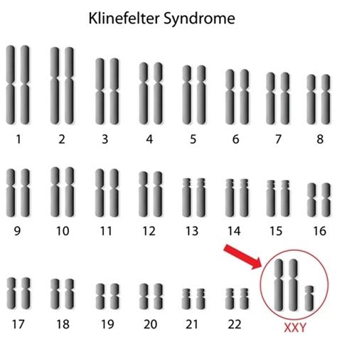 Famous People With Klinefelter Syndrome STD GOV Blog 2023