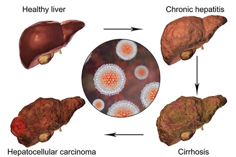 Learn more about the symptoms, diagnosis, and treatment of stage 4 copd. Stage 4 Bladder Cancer Treatment | Onco.com