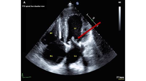 Recurrent Bioprosthetic Mitral Valve Thrombosis Treated With