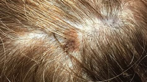 Melanoma Skin Cancer On Head