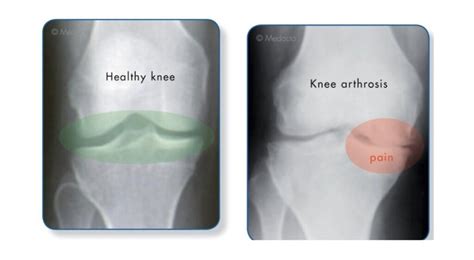 Knee Arthritis Midwest Orthopaedics