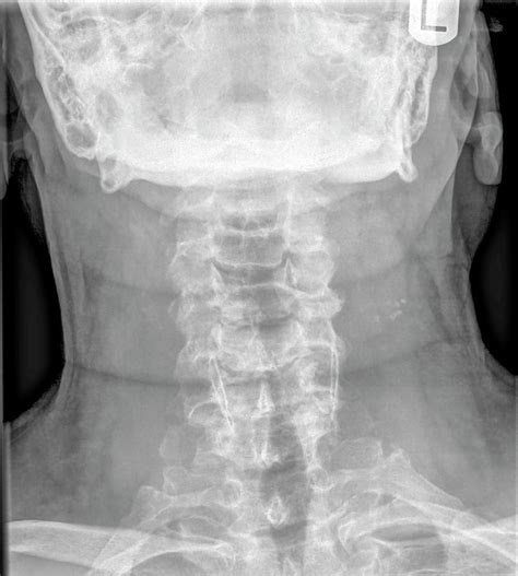 Normal Cervical Spine X Ray Photograph By Photostock Israel Pixels