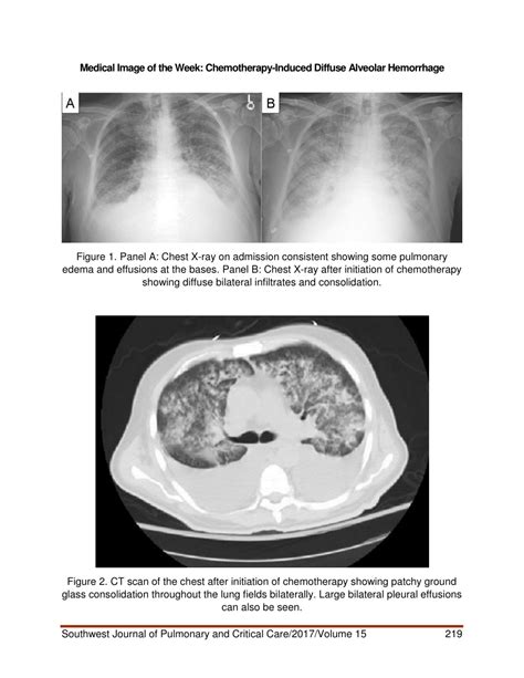 Pdf Medical Image Of The Week Chemotherapy Induced Diffuse Alveolar