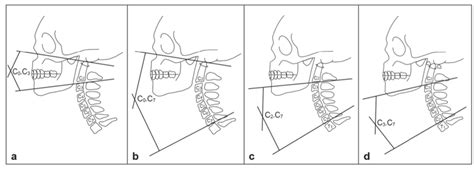 Cervical Cobb Angle Measurements Cervical Lordosis A Upper B