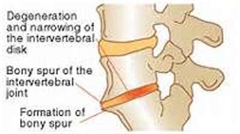 ( thanks in advance for any im new to this site but what have u done about spurs? 1000+ images about Bone Spurs In The Neck... on Pinterest ...