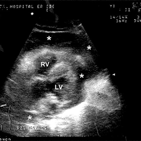 Bedside Ultrasound Of The Heart 15 Minutes After Rosc Showing Massive