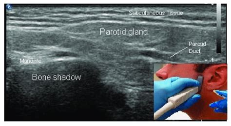 B Mode Ultrasound Image Parotid Salivary Gland Download Scientific
