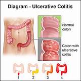 Pictures of Medical Treatment Of Ulcerative Colitis