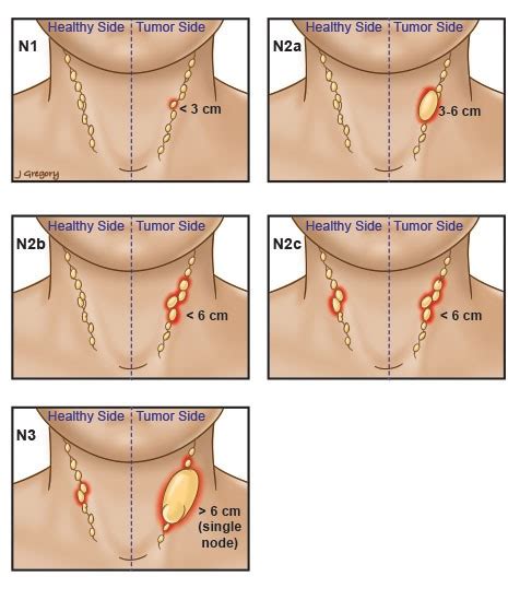 Oromandibular Jaw Cancer Wa Head And Neck Cancer