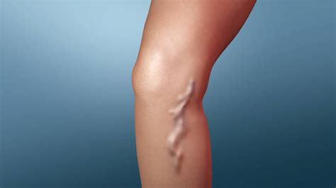 Natural Remedies For Varicose Veins You Should Definitely