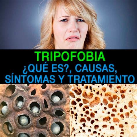 Tripofobia Qué Es Causas Síntomas Y Tratamiento La Guía De Las