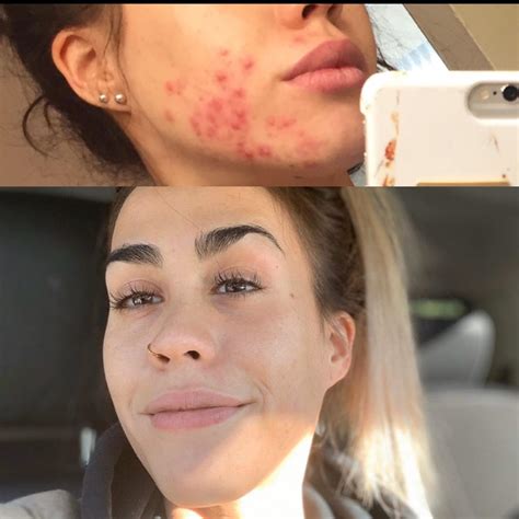 Skin Then Vs Skin Now I Had Such Painful Angry Cystic Acne