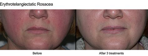 Dark spot laser removal before and after. Laser Dermatology