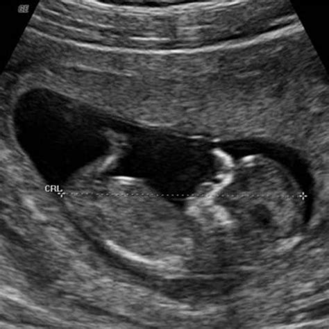 12 week ultrasound pictures gender