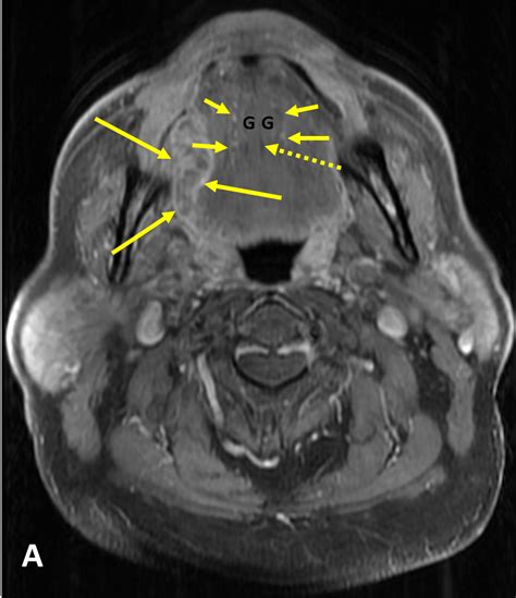 Squamous Cell Carcinoma Scca Tongue Diagnosis Mri Online
