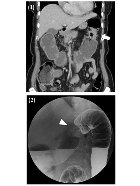 Apple Core Lesion Of Colon Adenocarcinoma By Barium Double Contrast