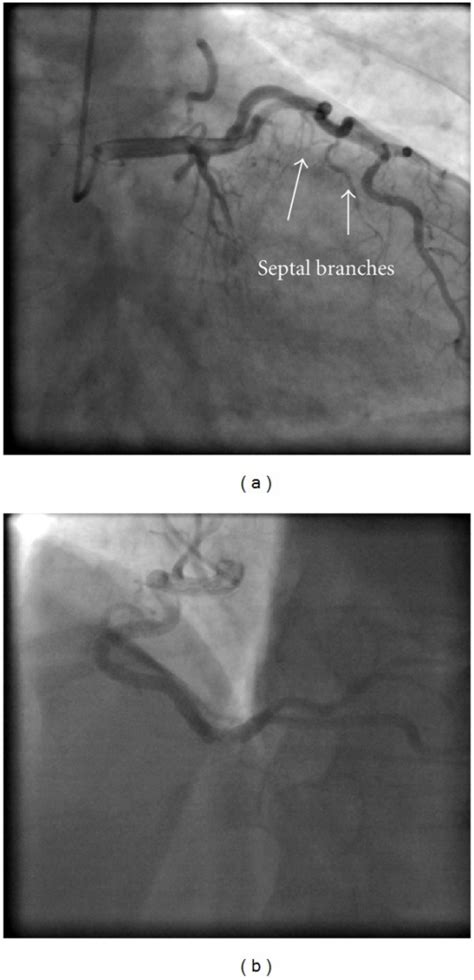 A Coronary Angiogram Shows Coronary Fistula From The Left Anterior