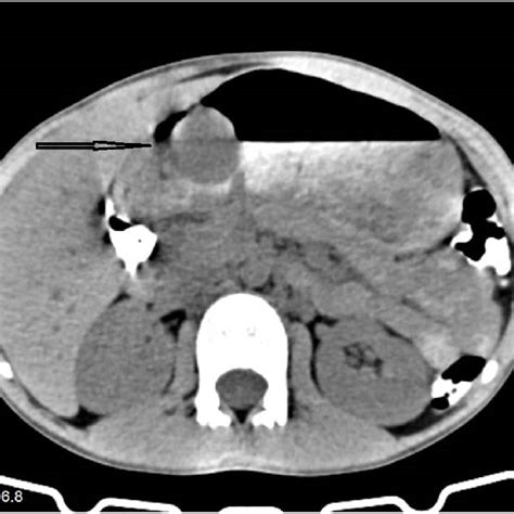 Abdominal Computed Tomography Ct Scan With Contrast Revealing A Large