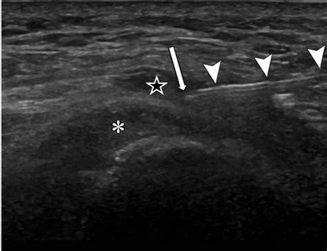 Us Guided Musculoskeletal Interventions In The Hip With Mri And Us