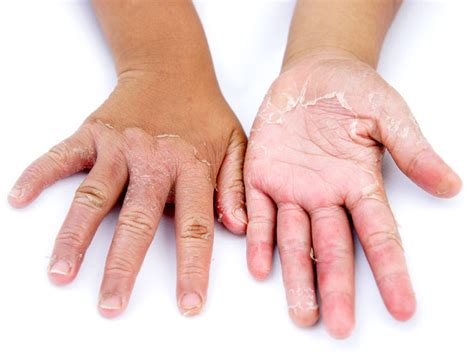 Nine Causes Of Peeling Skin Guardian Life The Guardian Nigeria News